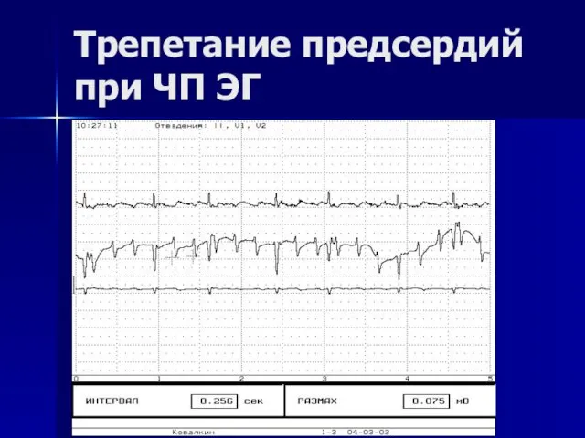 Трепетание предсердий при ЧП ЭГ