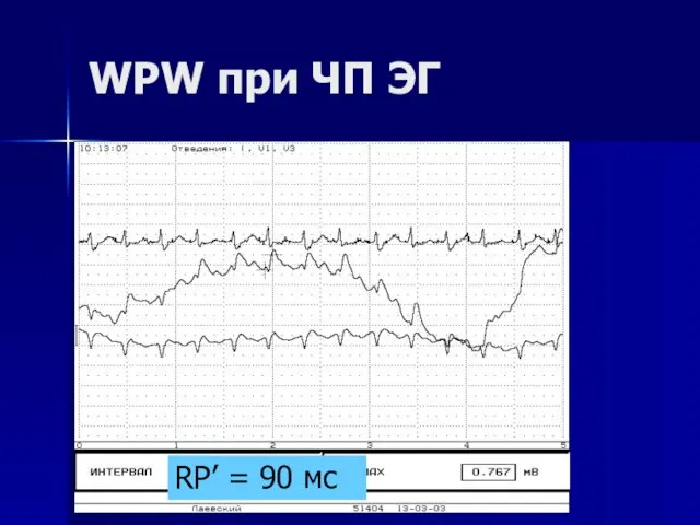 WPW при ЧП ЭГ RP’ = 90 мс