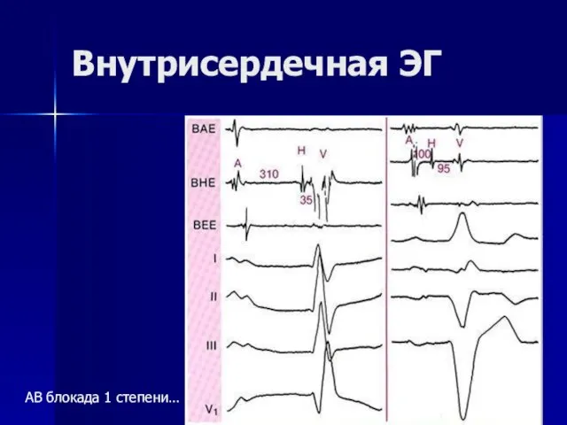 Внутрисердечная ЭГ АВ блокада 1 степени…