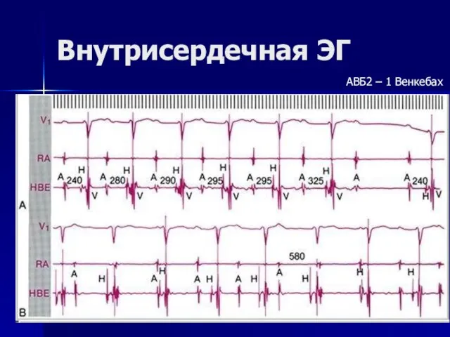 Внутрисердечная ЭГ АВБ2 – 1 Венкебах