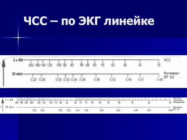 ЧСС – по ЭКГ линейке