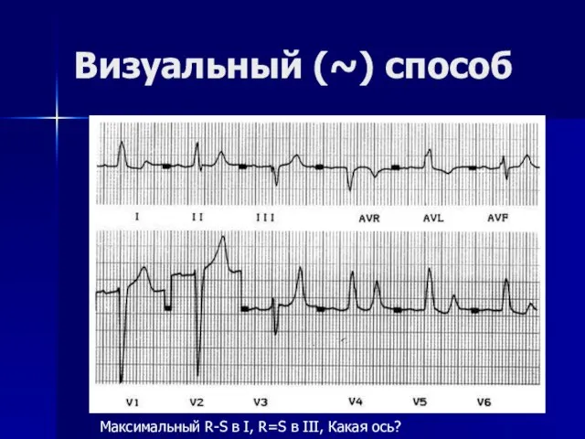 Визуальный (~) способ Максимальный R-S в I, R=S в III, Какая ось?