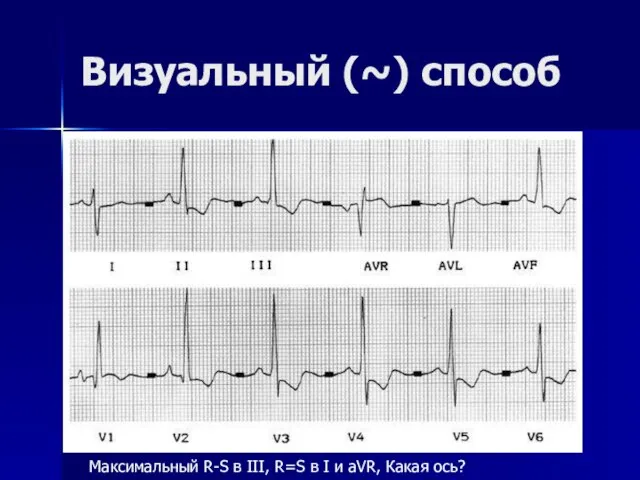 Визуальный (~) способ Максимальный R-S в III, R=S в I и aVR, Какая ось?