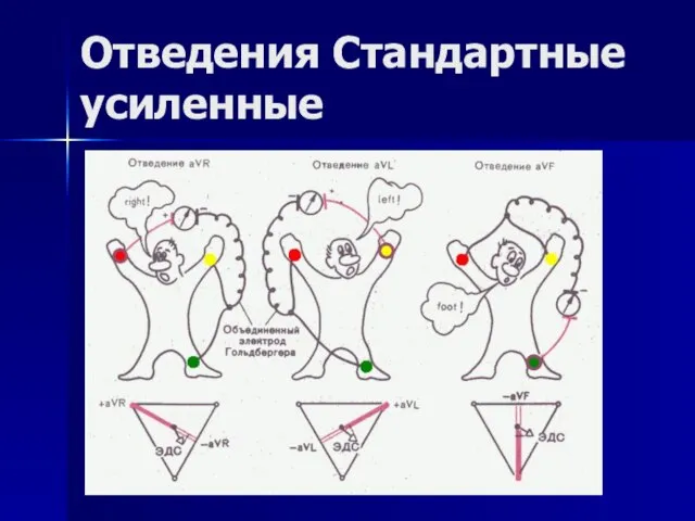 Отведения Стандартные усиленные