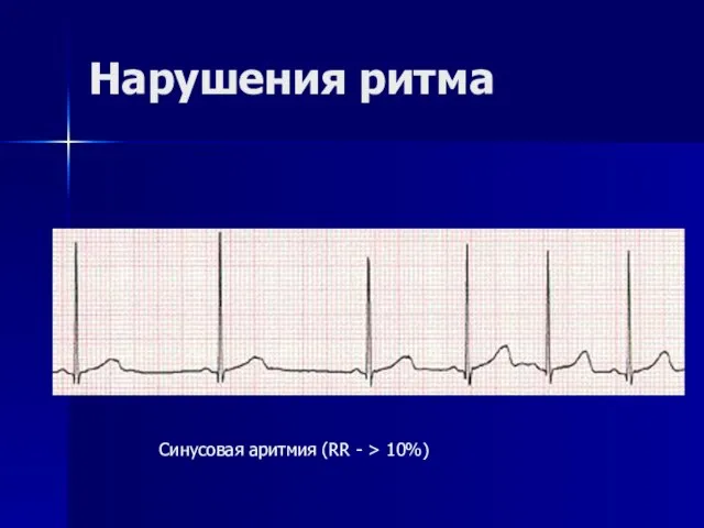 Нарушения ритма Синусовая аритмия (RR - > 10%)