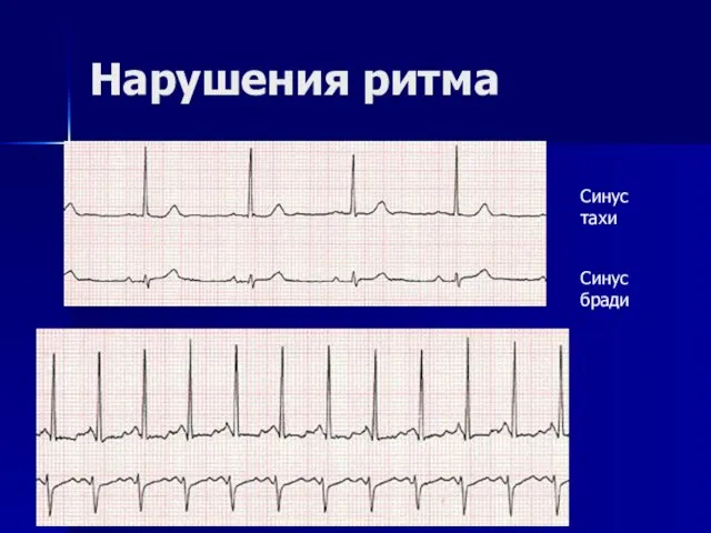 Нарушения ритма Синус тахи Синус бради