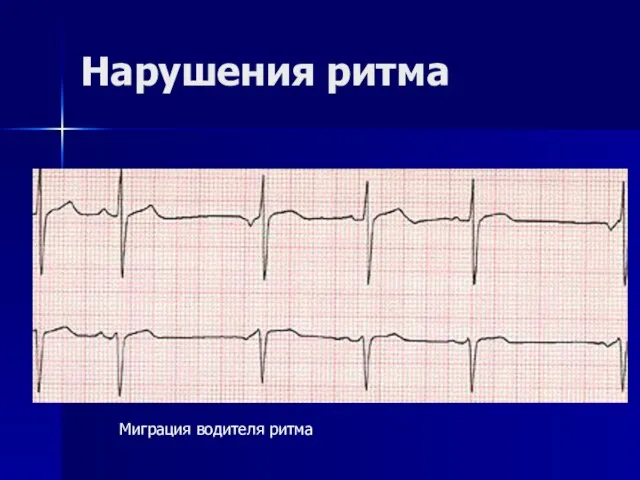 Нарушения ритма Миграция водителя ритма