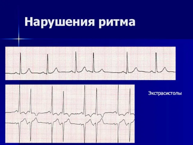 Нарушения ритма Экстрасистолы