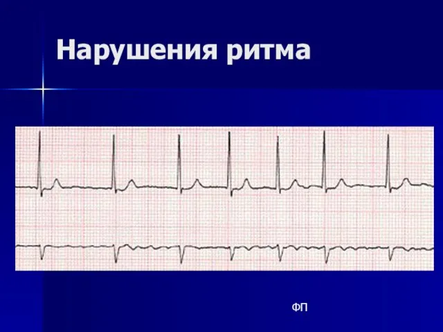 Нарушения ритма ФП