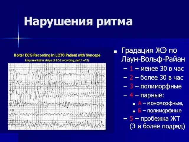 Нарушения ритма Градация ЖЭ по Лаун-Вольф-Райан 1 – менее 30 в час