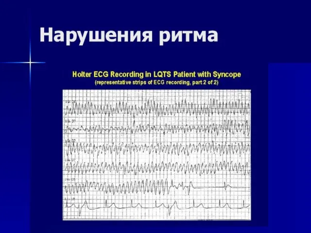Нарушения ритма