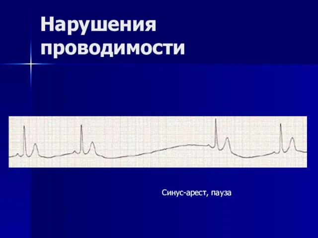 Нарушения проводимости Синус-арест, пауза