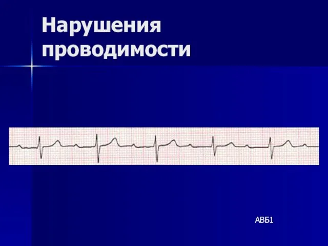 Нарушения проводимости АВБ1