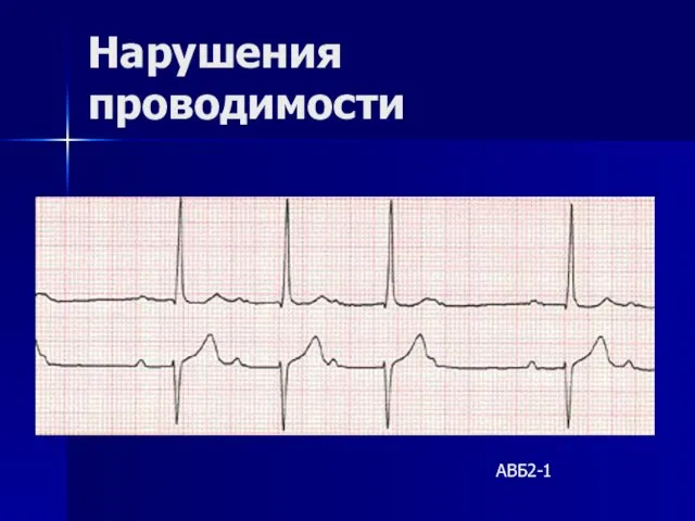 Нарушения проводимости АВБ2-1