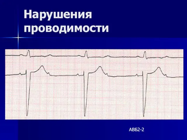 Нарушения проводимости АВБ2-2