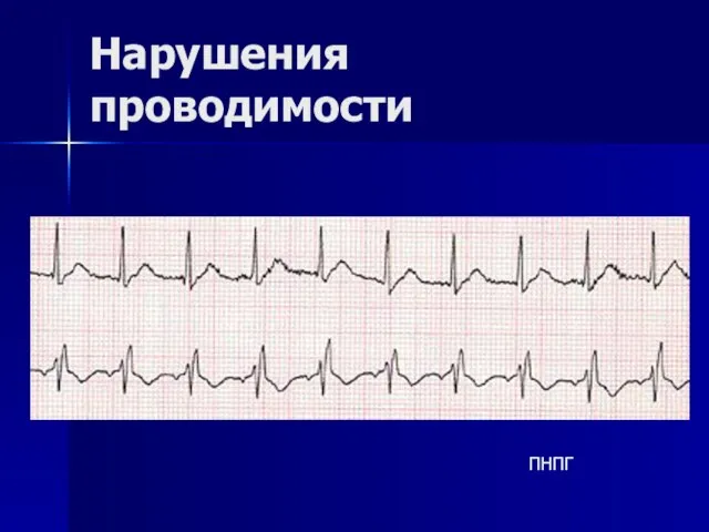 Нарушения проводимости ПНПГ