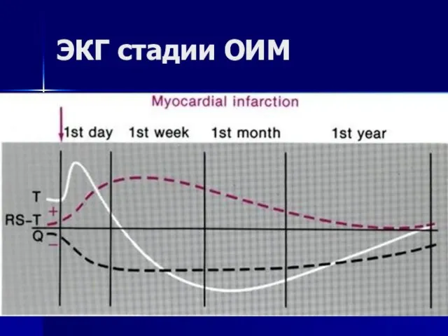 ЭКГ стадии ОИМ