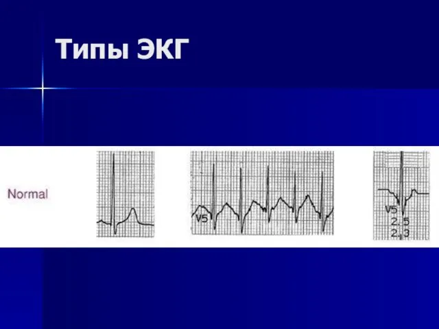 Типы ЭКГ
