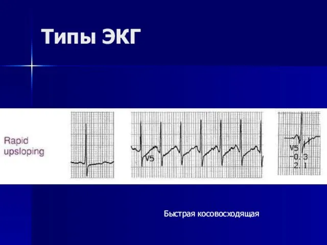 Типы ЭКГ Быстрая косовосходящая