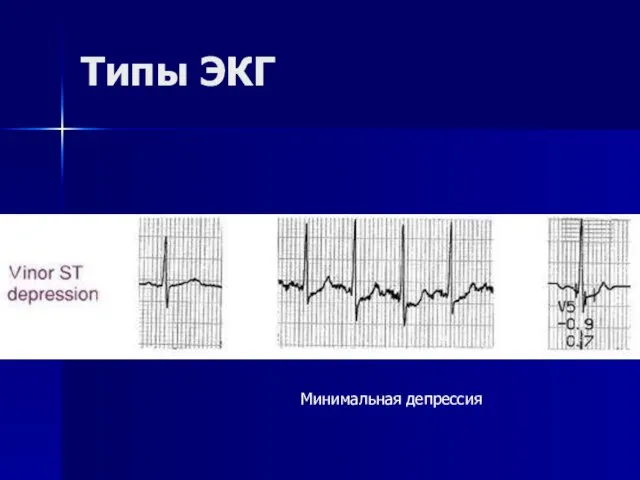 Типы ЭКГ Минимальная депрессия