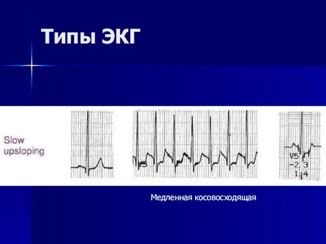 Типы ЭКГ Медленная косовосходящая