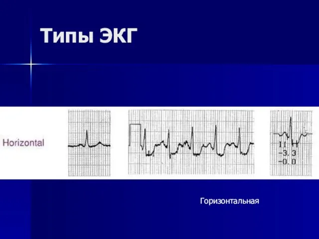 Типы ЭКГ Горизонтальная