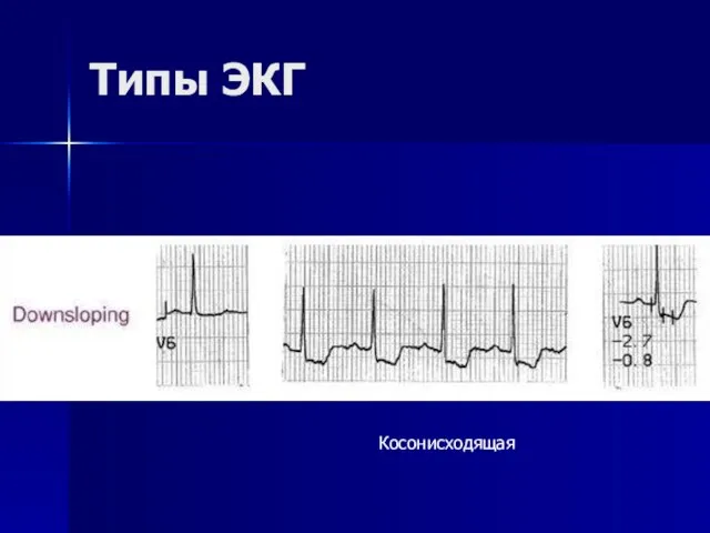 Типы ЭКГ Косонисходящая