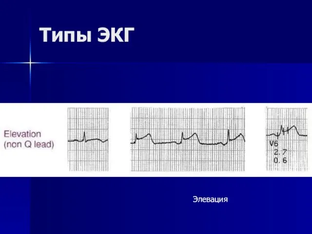 Типы ЭКГ Элевация