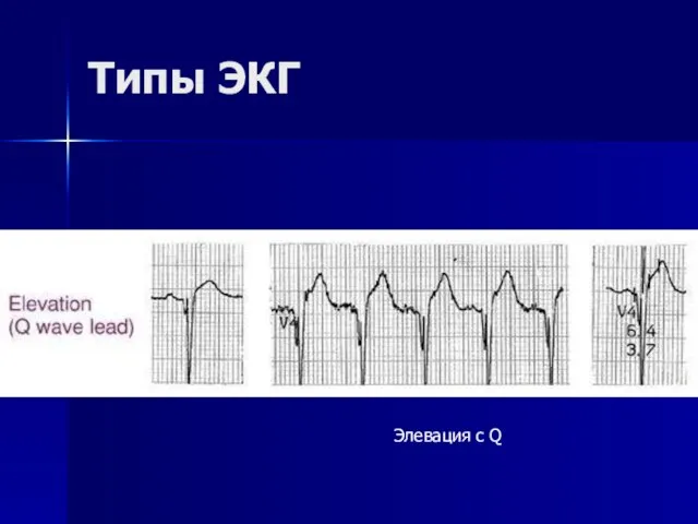 Типы ЭКГ Элевация с Q