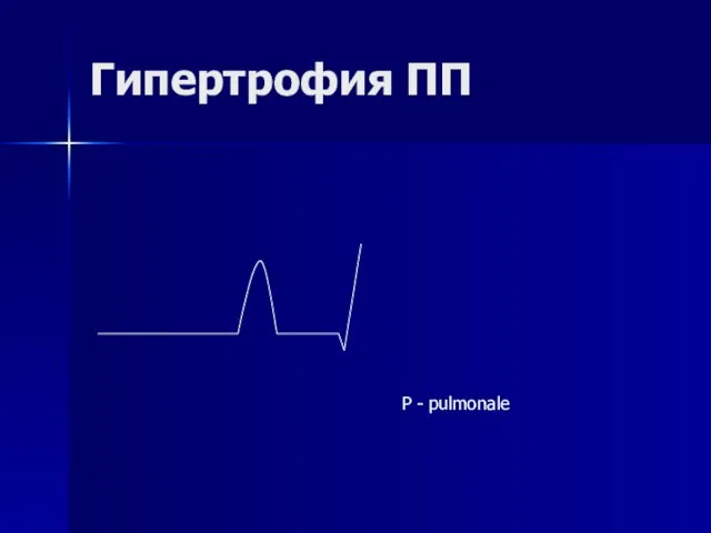 Гипертрофия ПП Р - pulmonale