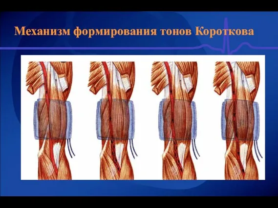 Механизм формирования тонов Короткова