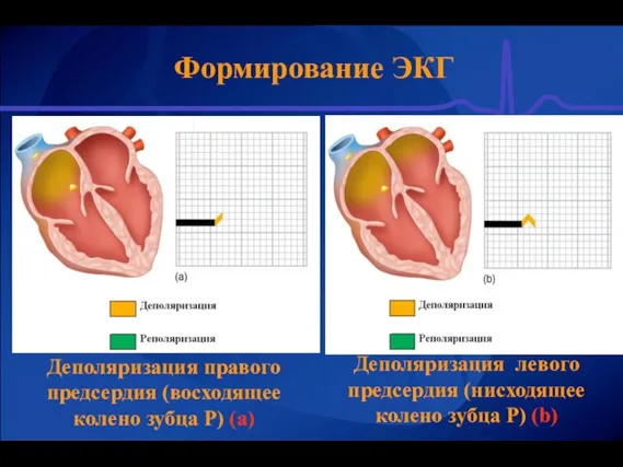 Формирование ЭКГ Деполяризация правого предсердия (восходящее колено зубца Р) (а) Деполяризация левого