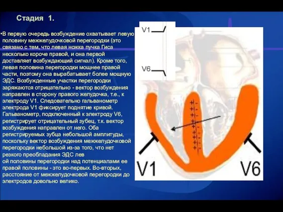 Стадия 1. . В первую очередь возбуждение охватывает левую половину межжелудочковой перегородки