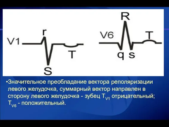 Значительное преобладание вектора реполяризации левого желудочка, суммарный вектор направлен в сторону левого