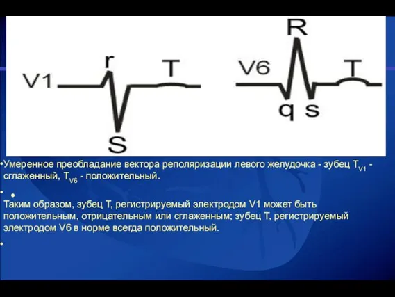 Умеренное преобладание вектора реполяризации левого желудочка - зубец TV1 - сглаженный, TV6