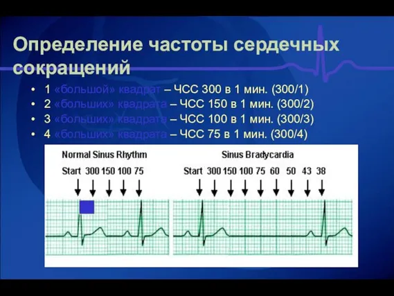 Определение частоты сердечных сокращений 1 «большой» квадрат – ЧСС 300 в 1