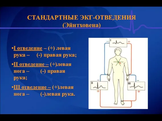 СТАНДАРТНЫЕ ЭКГ-ОТВЕДЕНИЯ (Эйнтховена) I отведение – (+) левая рука – (-) правая