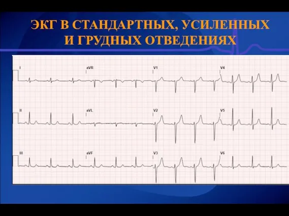 ЭКГ В СТАНДАРТНЫХ, УСИЛЕННЫХ И ГРУДНЫХ ОТВЕДЕНИЯХ