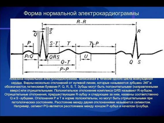 Форма нормальной электрокардиограммы показана нормальная электрокардиограмма, записанная в течение одного цикла возбуждения