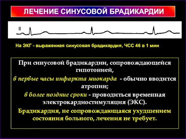 При синусовой брадикардии, сопровождающейся гипотонией, в первые часы инфаркта миокарда - обычно