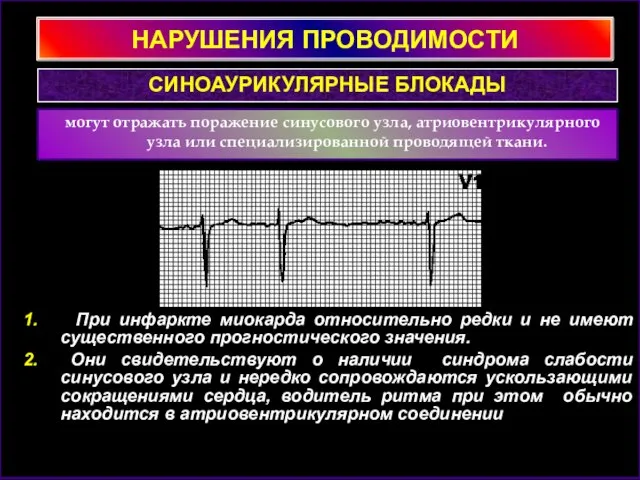 НАРУШЕНИЯ ПРОВОДИМОСТИ могут отражать поражение синусового узла, атриовентрикулярного узла или специализированной проводящей