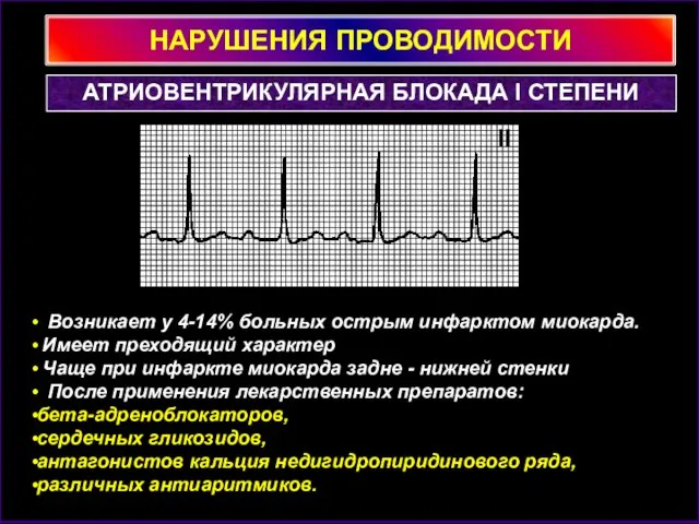 НАРУШЕНИЯ ПРОВОДИМОСТИ АТРИОВЕНТРИКУЛЯРНАЯ БЛОКАДА I СТЕПЕНИ Возникает у 4-14% больных острым инфарктом