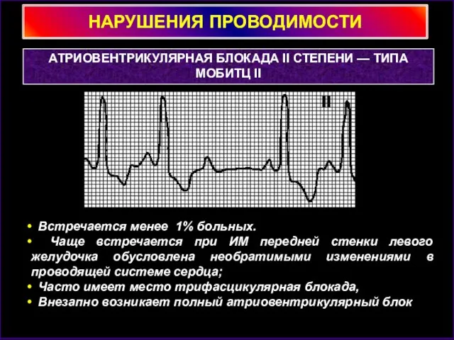 НАРУШЕНИЯ ПРОВОДИМОСТИ АТРИОВЕНТРИКУЛЯРНАЯ БЛОКАДА II СТЕПЕНИ — ТИПА МОБИТЦ II Встречается менее