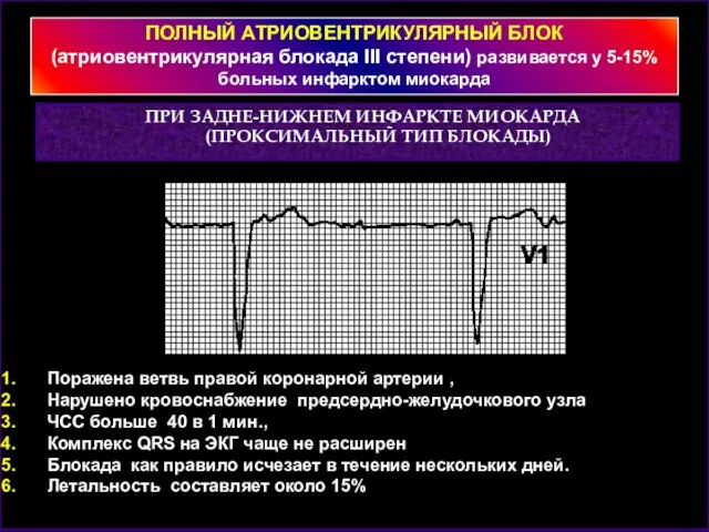 ПРИ ЗАДНЕ-НИЖНЕМ ИНФАРКТЕ МИОКАРДА (ПРОКСИМАЛЬНЫЙ ТИП БЛОКАДЫ) ПОЛНЫЙ АТРИОВЕНТРИКУЛЯРНЫЙ БЛОК (атриовентрикулярная блокада