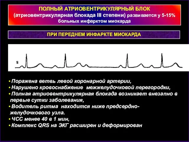 ПОЛНЫЙ АТРИОВЕНТРИКУЛЯРНЫЙ БЛОК (атриовентрикулярная блокада III степени) развивается у 5-15% больных инфарктом