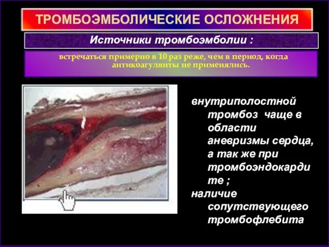 ТРОМБОЭМБОЛИЧЕСКИЕ ОСЛОЖНЕНИЯ встречаться примерно в 10 раз реже, чем в период, когда