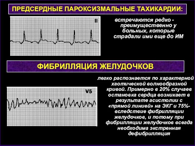 ПРЕДСЕРДНЫЕ ПАРОКСИЗМАЛЬНЫЕ ТАХИКАРДИИ: встречаются редко - преимущественно у больных, которые страдали ими