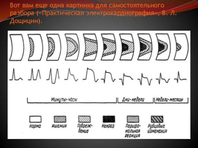 Вот вам еще одна картинка для самостоятельного разбора («Практическая электрокардиография», В. Л. Дощицин).
