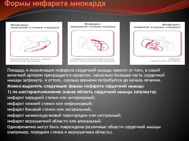 Формы инфаркта миокарда Площадь и локализация инфаркта сердечной мышцы зависят от того,