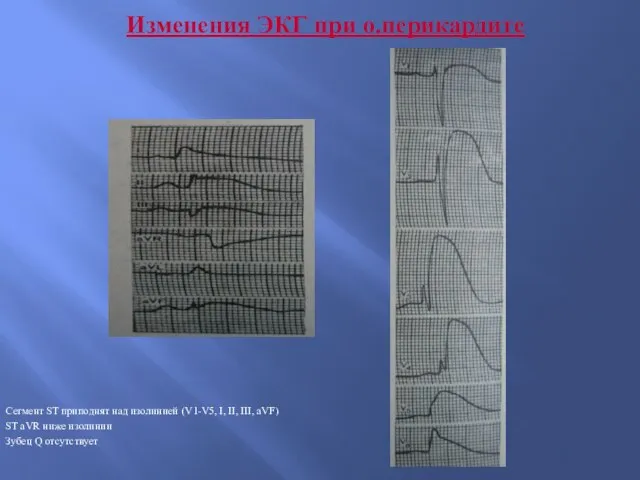 Изменения ЭКГ при о.перикардите Сегмент ST приподнят над изолинией (V1-V5, I, II,